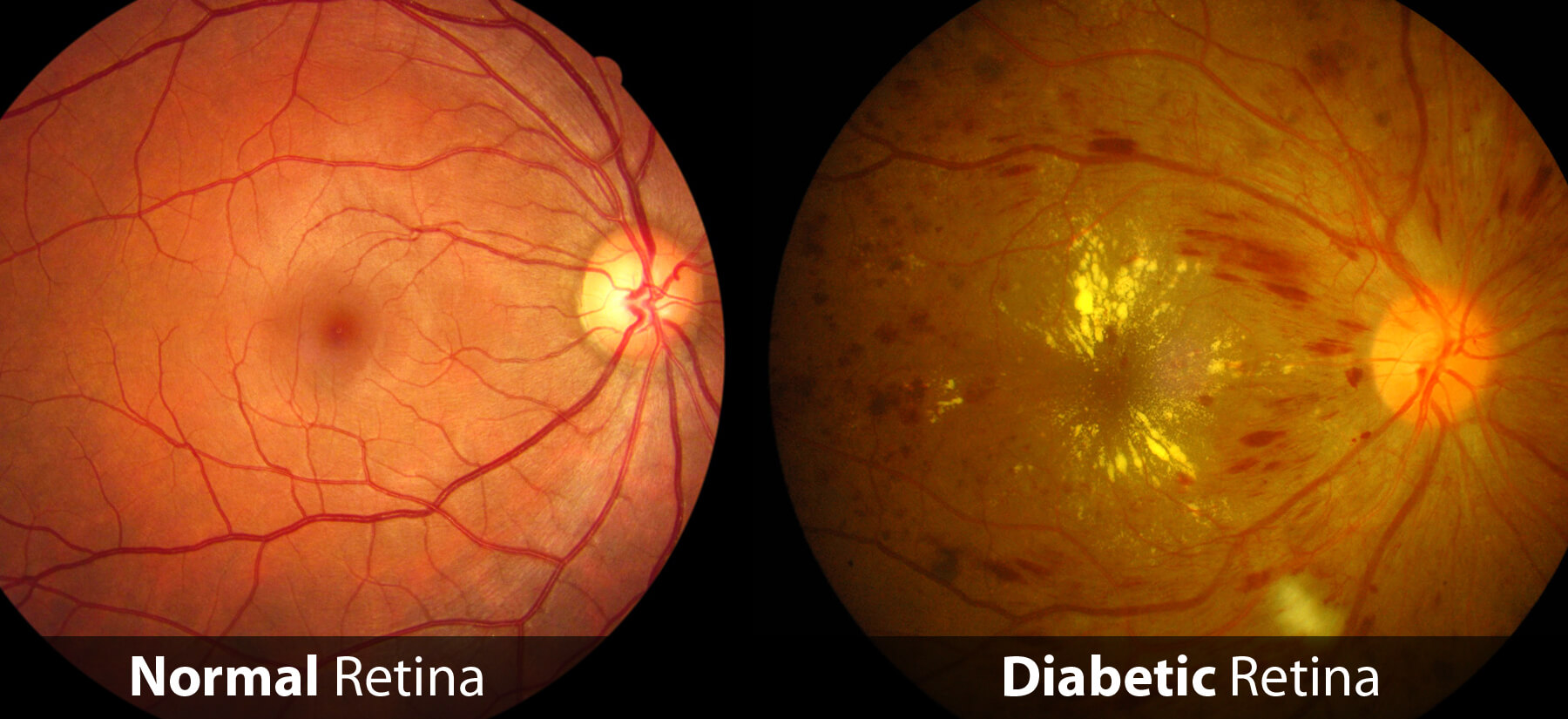 Diabetic retinopathy eye exam