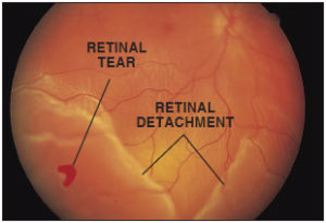 Retinal Tear and Detachment Examples