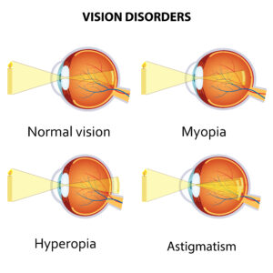Diagram showing the difference between normal vision, myopia, hyperopia and astigmatism